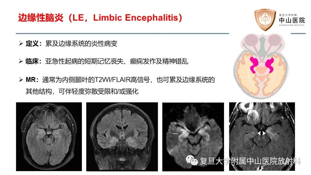 影像PPT - 【病例】边缘性脑炎—自身免疫性脑炎 VS 病毒性脑炎-12