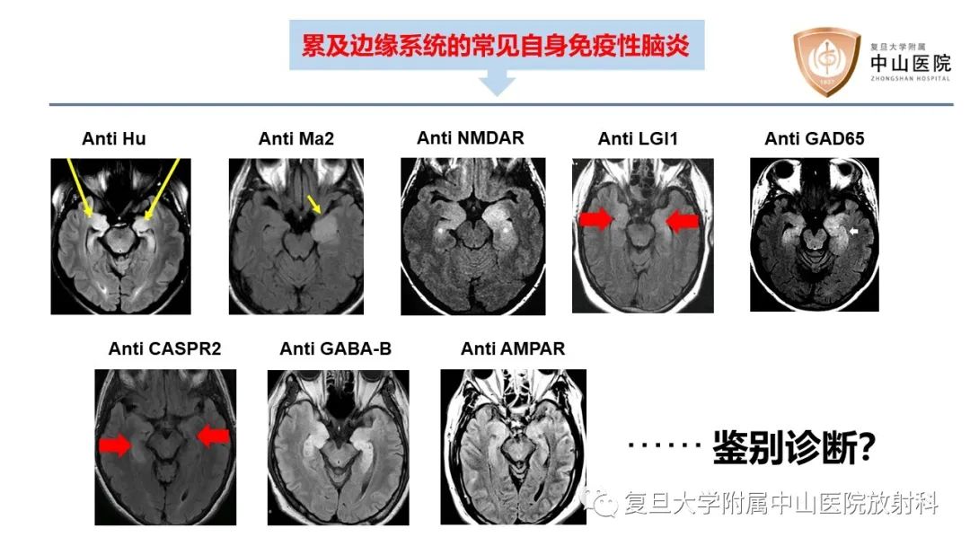 影像PPT - 【病例】边缘性脑炎—自身免疫性脑炎 VS 病毒性脑炎-15