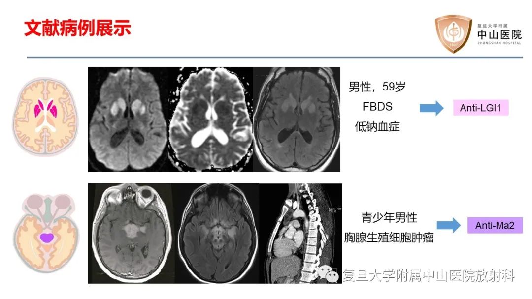 影像PPT - 【病例】边缘性脑炎—自身免疫性脑炎 VS 病毒性脑炎-17