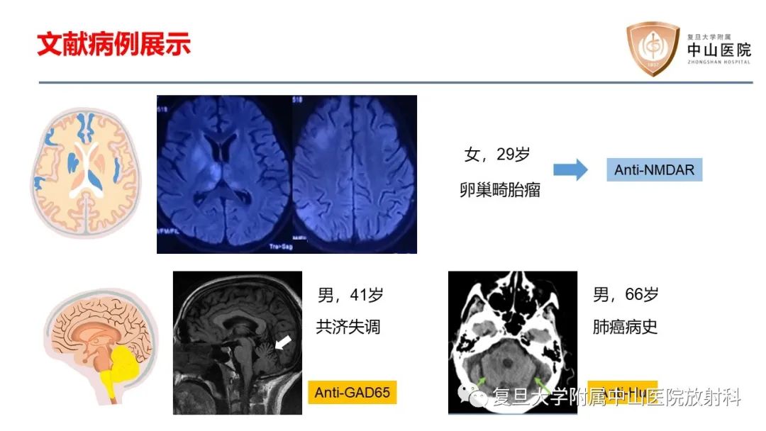 影像PPT - 【病例】边缘性脑炎—自身免疫性脑炎 VS 病毒性脑炎-18