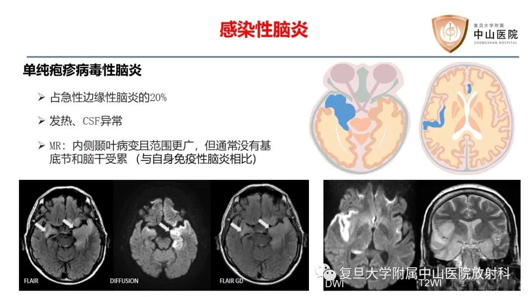 影像PPT - 【病例】边缘性脑炎—自身免疫性脑炎 VS 病毒性脑炎-19