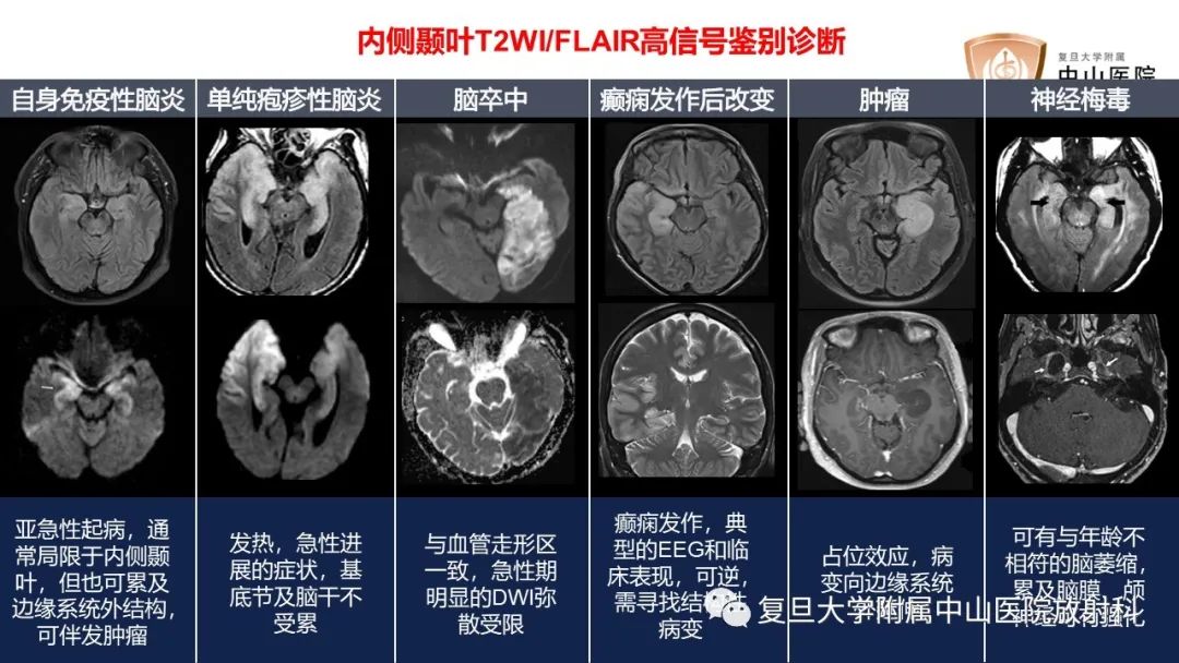 影像PPT - 【病例】边缘性脑炎—自身免疫性脑炎 VS 病毒性脑炎-20