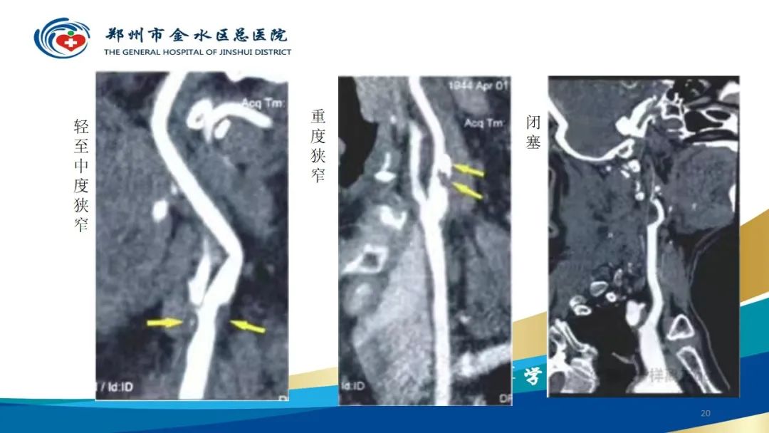 影像PPT - 【PPT】头颈CTA扫描技术与临床应用-20