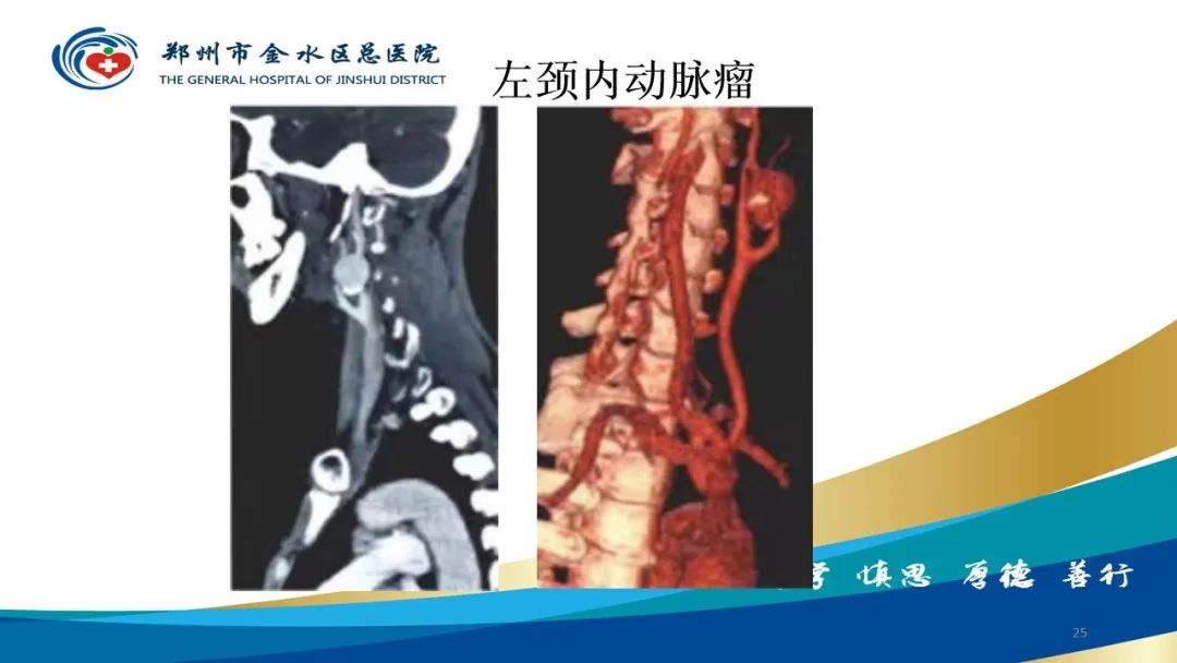 影像PPT - 【PPT】头颈CTA扫描技术与临床应用-25