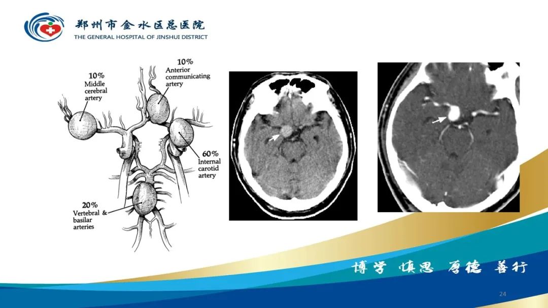 影像PPT - 【PPT】头颈CTA扫描技术与临床应用-24