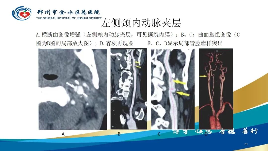 影像PPT - 【PPT】头颈CTA扫描技术与临床应用-29
