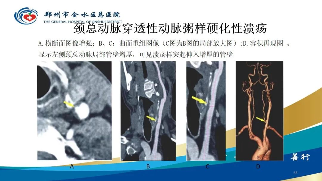 影像PPT - 【PPT】头颈CTA扫描技术与临床应用-33