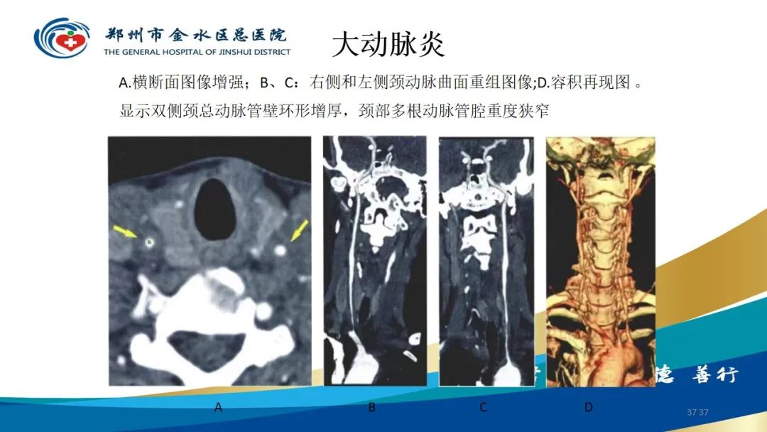影像PPT - 【PPT】头颈CTA扫描技术与临床应用-37