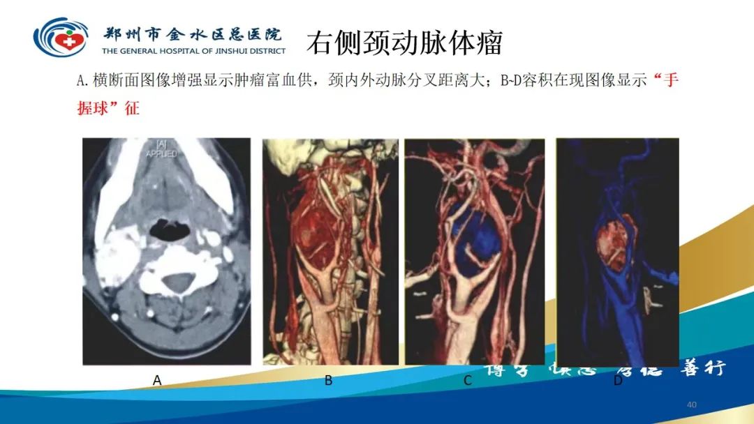 影像PPT - 【PPT】头颈CTA扫描技术与临床应用-40