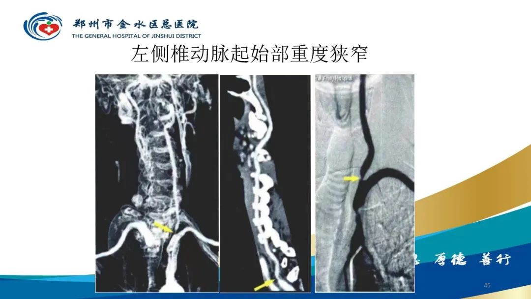影像PPT - 【PPT】头颈CTA扫描技术与临床应用-45