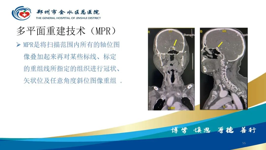 影像PPT - 【PPT】头颈CTA扫描技术与临床应用-55