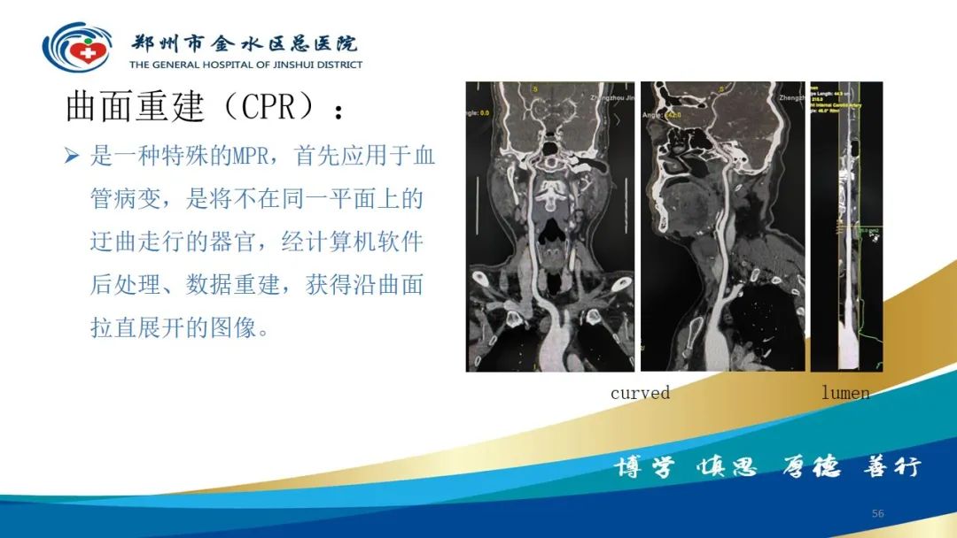 影像PPT - 【PPT】头颈CTA扫描技术与临床应用-56