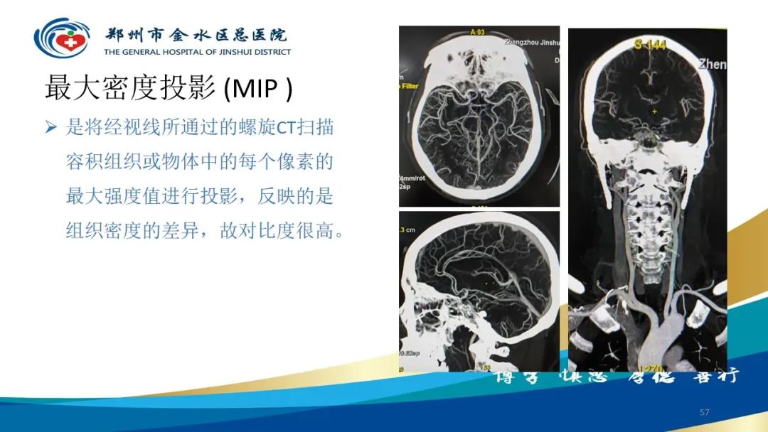 影像PPT - 【PPT】头颈CTA扫描技术与临床应用-57