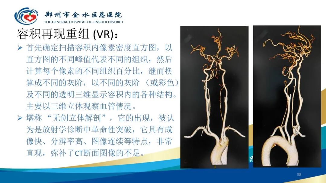 影像PPT - 【PPT】头颈CTA扫描技术与临床应用-58