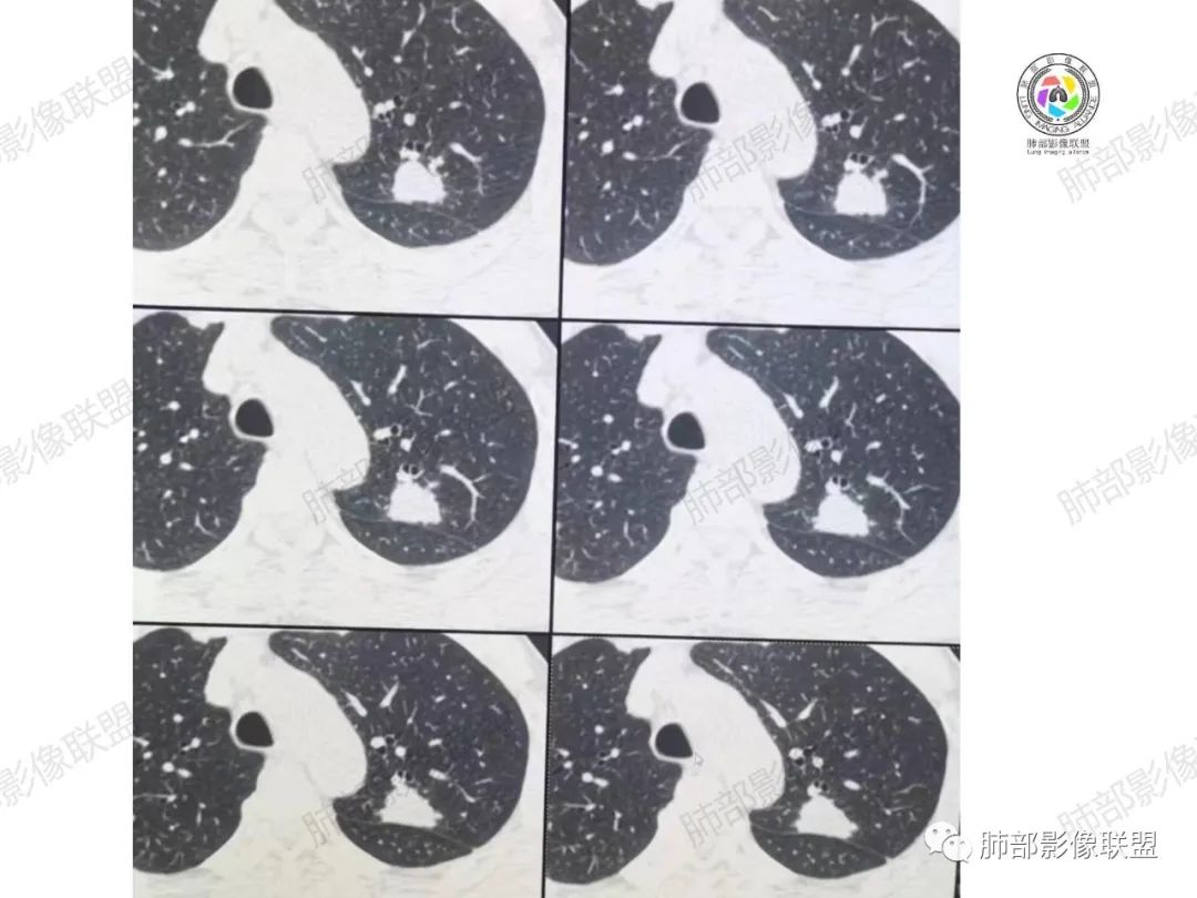 影像PPT - 【病例】肉芽肿性结节与腺癌的鉴别思路分析-13 影像PPT - 【病例】肉芽肿性结节与腺癌的鉴别思路分析-13