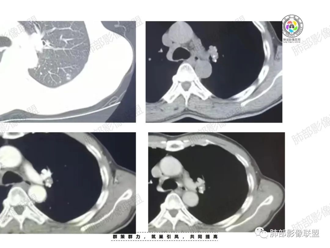 影像PPT - 【病例】肉芽肿性结节与腺癌的鉴别思路分析-10 影像PPT - 【病例】肉芽肿性结节与腺癌的鉴别思路分析-10