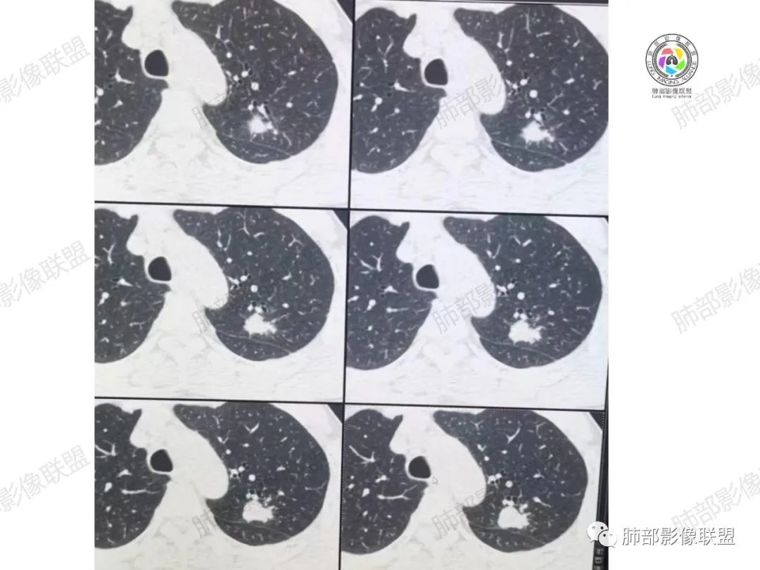 影像PPT - 【病例】肉芽肿性结节与腺癌的鉴别思路分析-12 影像PPT - 【病例】肉芽肿性结节与腺癌的鉴别思路分析-12