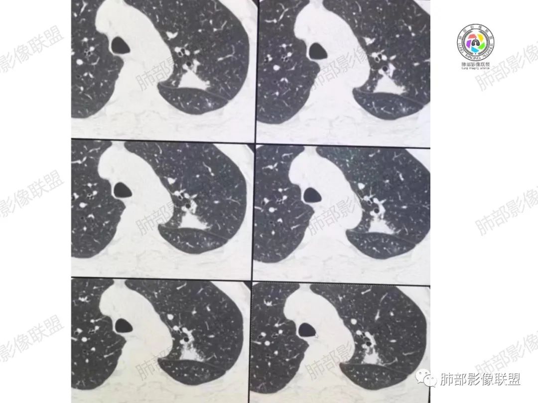影像PPT - 【病例】肉芽肿性结节与腺癌的鉴别思路分析-15 影像PPT - 【病例】肉芽肿性结节与腺癌的鉴别思路分析-15
