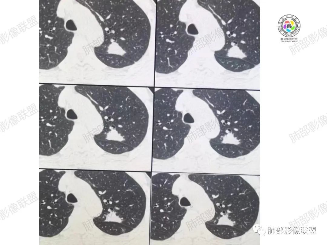 影像PPT - 【病例】肉芽肿性结节与腺癌的鉴别思路分析-14 影像PPT - 【病例】肉芽肿性结节与腺癌的鉴别思路分析-14