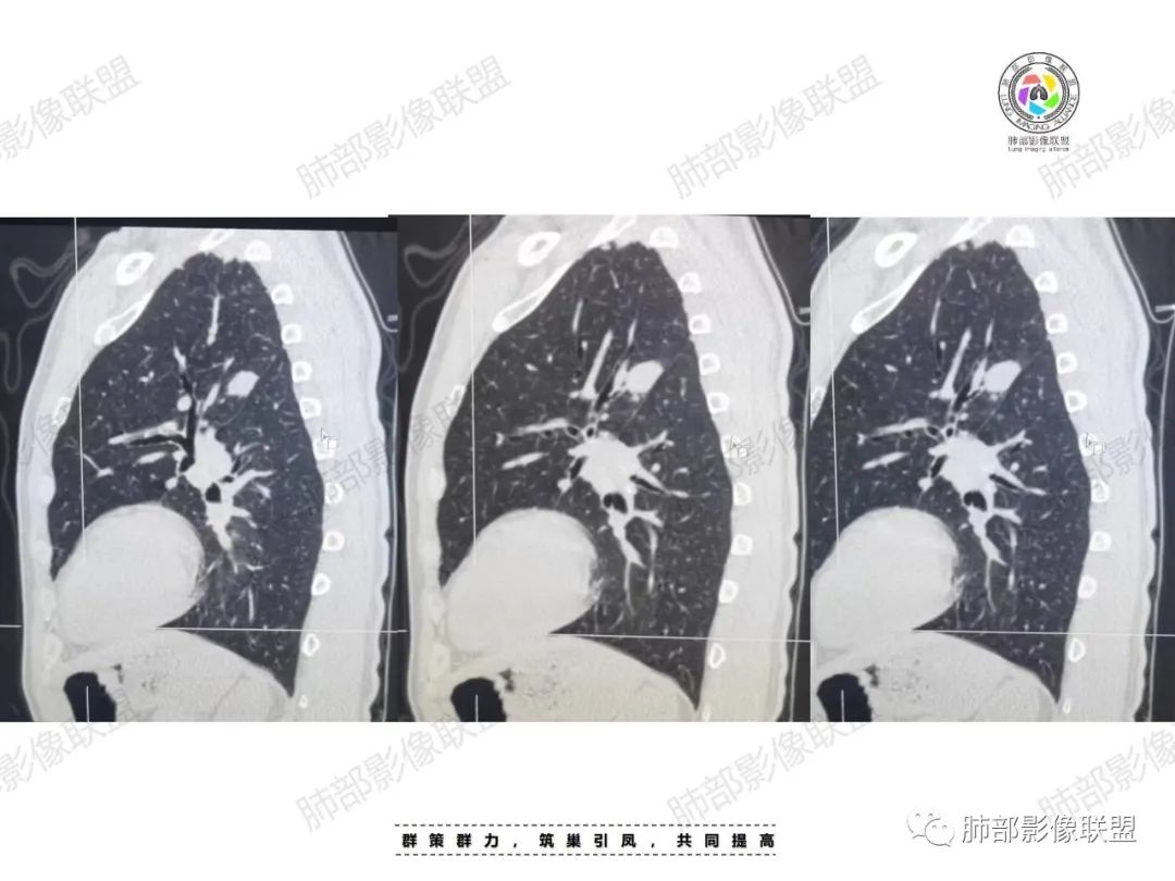 影像PPT - 【病例】肉芽肿性结节与腺癌的鉴别思路分析-19 影像PPT - 【病例】肉芽肿性结节与腺癌的鉴别思路分析-19