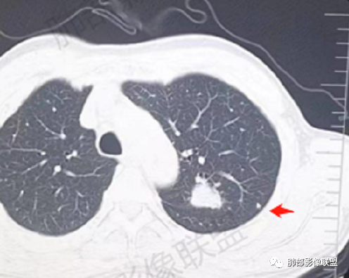 影像PPT - 【病例】肉芽肿性结节与腺癌的鉴别思路分析-25 影像PPT - 【病例】肉芽肿性结节与腺癌的鉴别思路分析-25