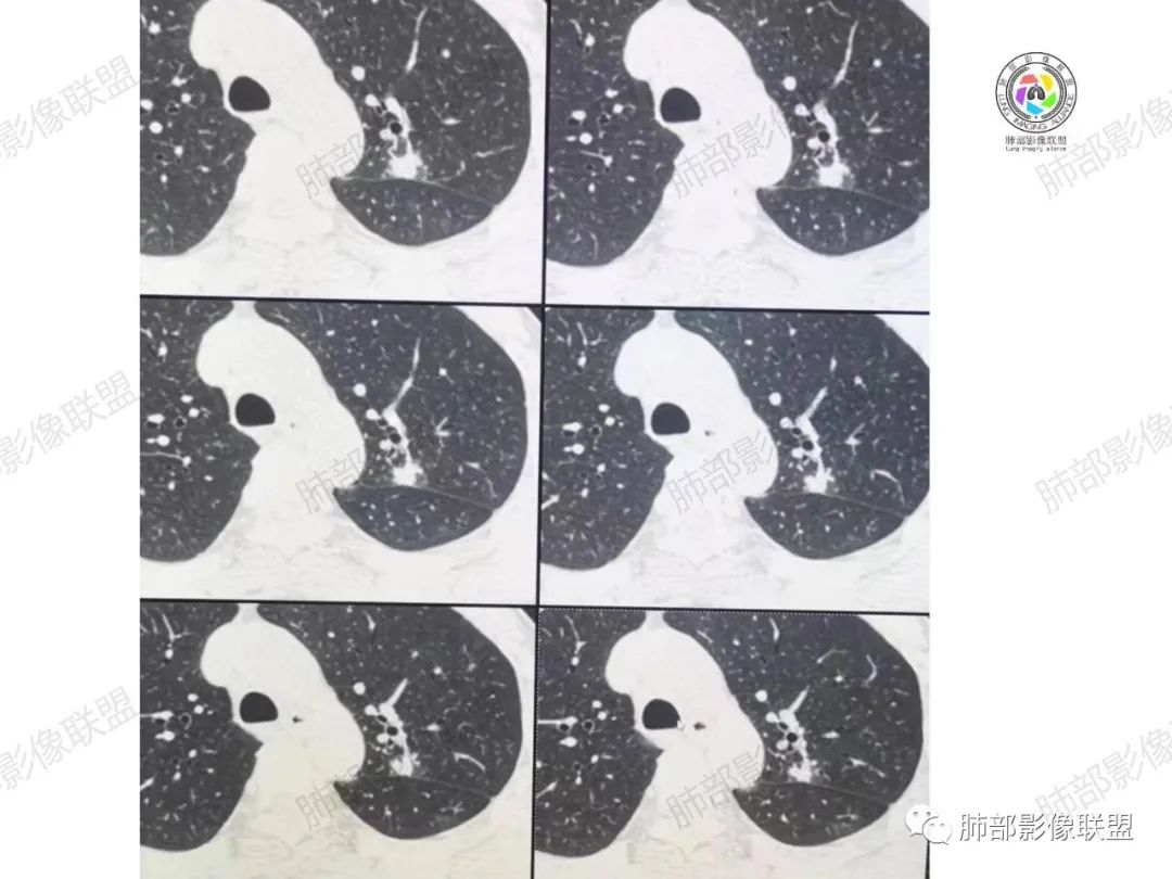 影像PPT - 【病例】肉芽肿性结节与腺癌的鉴别思路分析-16 影像PPT - 【病例】肉芽肿性结节与腺癌的鉴别思路分析-16