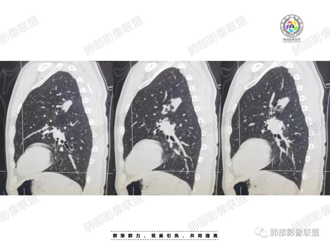影像PPT - 【病例】肉芽肿性结节与腺癌的鉴别思路分析-20 影像PPT - 【病例】肉芽肿性结节与腺癌的鉴别思路分析-20