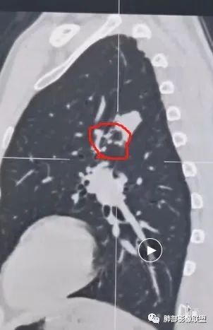 影像PPT - 【病例】肉芽肿性结节与腺癌的鉴别思路分析-30 影像PPT - 【病例】肉芽肿性结节与腺癌的鉴别思路分析-30