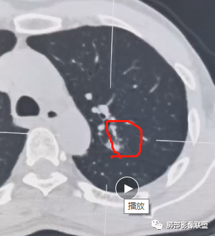 影像PPT - 【病例】肉芽肿性结节与腺癌的鉴别思路分析-28 影像PPT - 【病例】肉芽肿性结节与腺癌的鉴别思路分析-28