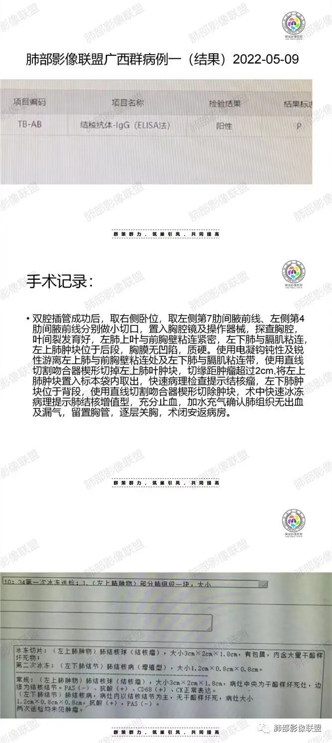 影像PPT - 【病例】肉芽肿性结节与腺癌的鉴别思路分析-31 影像PPT - 【病例】肉芽肿性结节与腺癌的鉴别思路分析-31