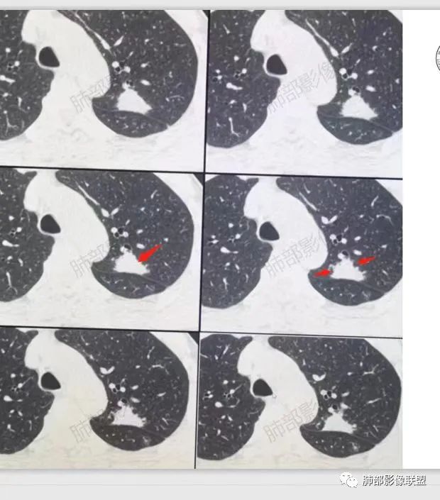 影像PPT - 【病例】肉芽肿性结节与腺癌的鉴别思路分析-33 影像PPT - 【病例】肉芽肿性结节与腺癌的鉴别思路分析-33