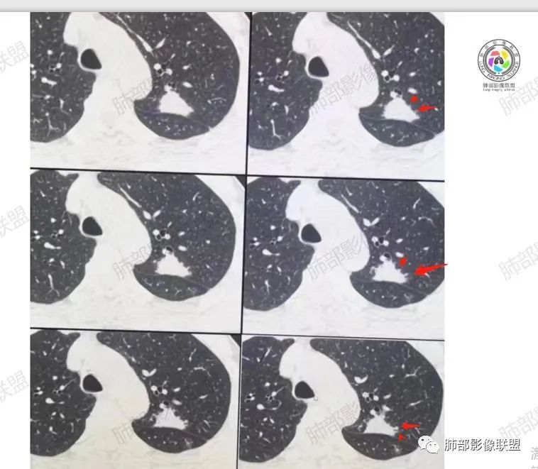 影像PPT - 【病例】肉芽肿性结节与腺癌的鉴别思路分析-34 影像PPT - 【病例】肉芽肿性结节与腺癌的鉴别思路分析-34