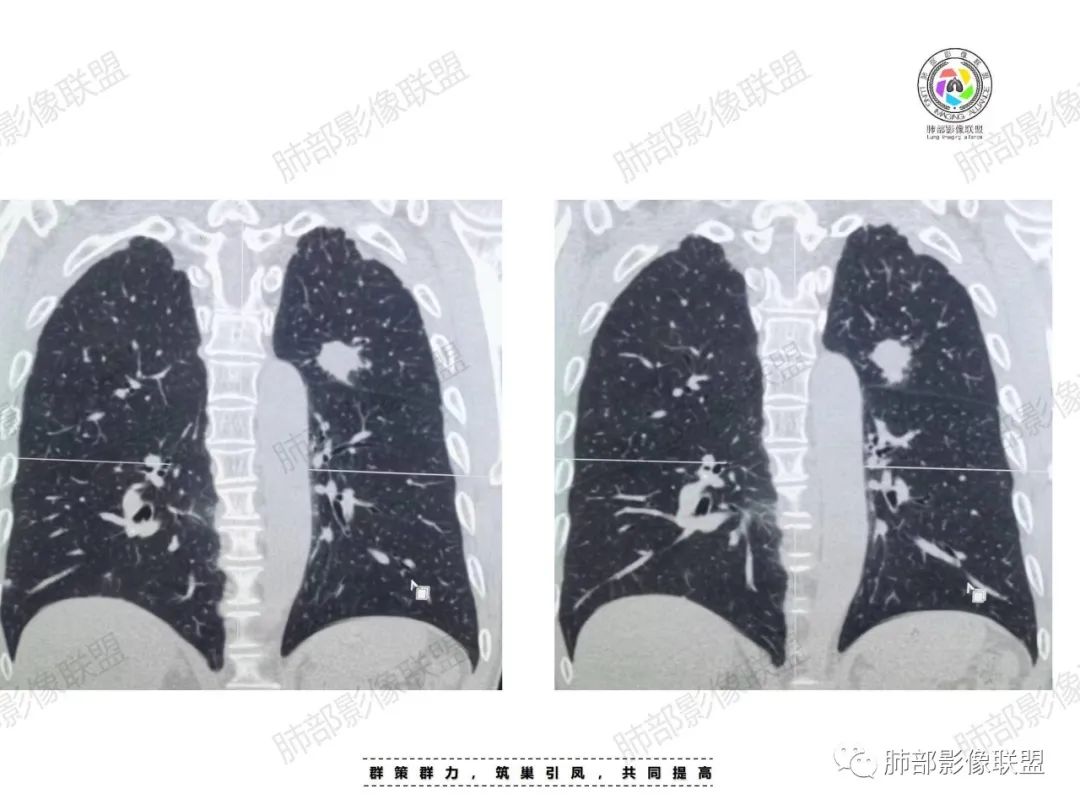 影像PPT - 【病例】肉芽肿性结节与腺癌的鉴别思路分析-18 影像PPT - 【病例】肉芽肿性结节与腺癌的鉴别思路分析-18
