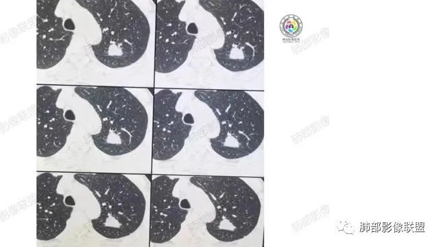 影像PPT - 【病例】肉芽肿性结节与腺癌的鉴别思路分析-32 影像PPT - 【病例】肉芽肿性结节与腺癌的鉴别思路分析-32