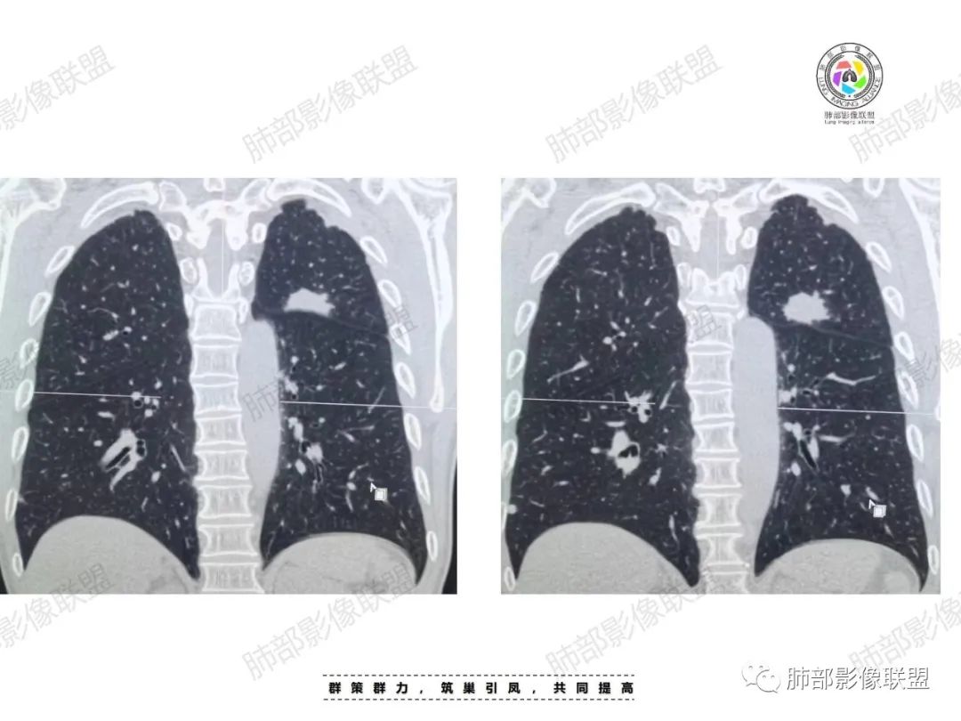 影像PPT - 【病例】肉芽肿性结节与腺癌的鉴别思路分析-17 影像PPT - 【病例】肉芽肿性结节与腺癌的鉴别思路分析-17