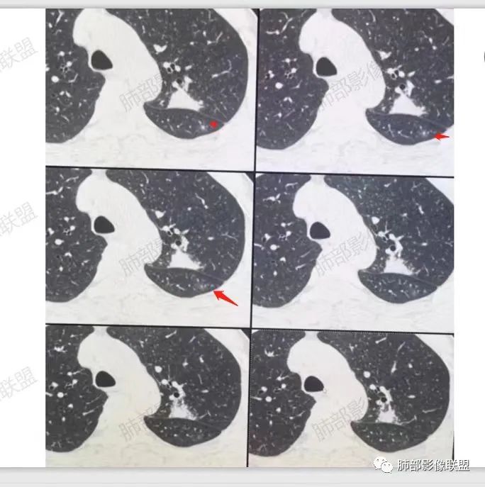 影像PPT - 【病例】肉芽肿性结节与腺癌的鉴别思路分析-36 影像PPT - 【病例】肉芽肿性结节与腺癌的鉴别思路分析-36