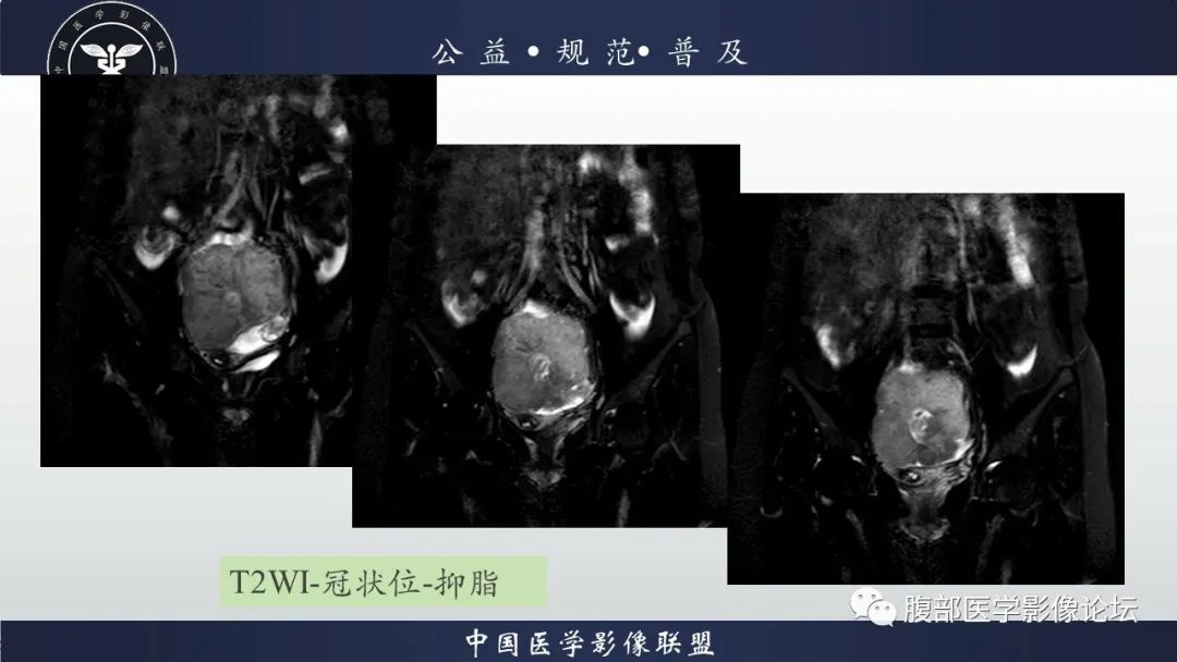 影像PPT - 【病例】卵巢子宫内膜样癌1例MR-5