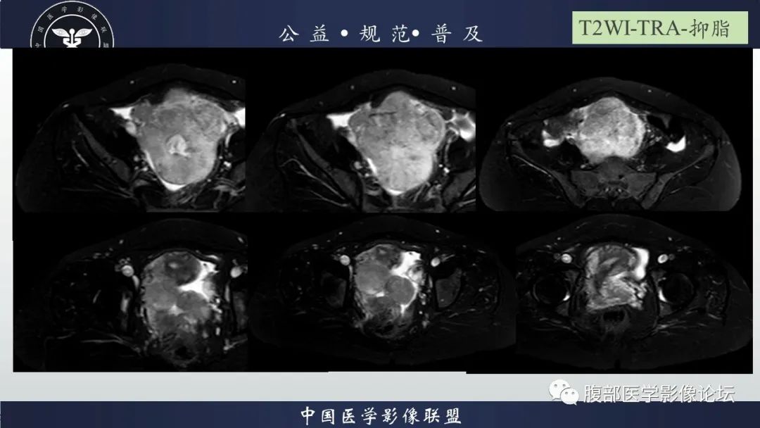 影像PPT - 【病例】卵巢子宫内膜样癌1例MR-6