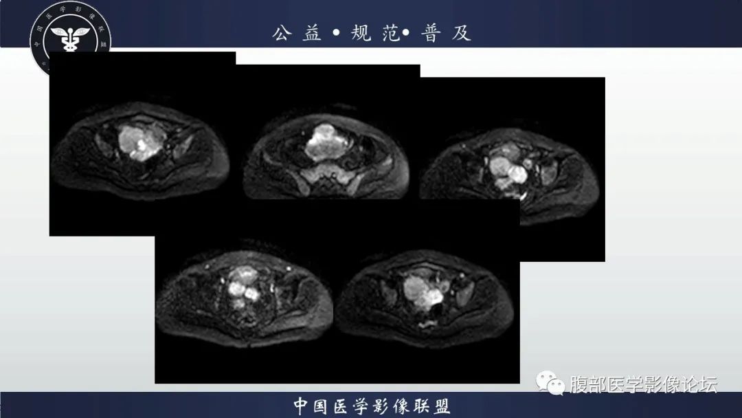 影像PPT - 【病例】卵巢子宫内膜样癌1例MR-8