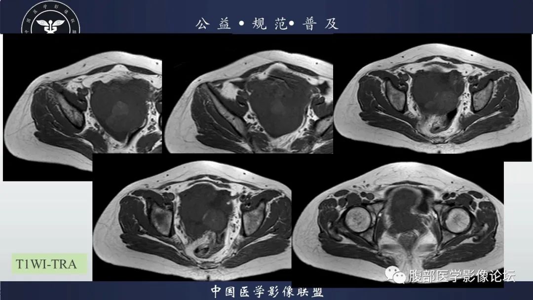 影像PPT - 【病例】卵巢子宫内膜样癌1例MR-7