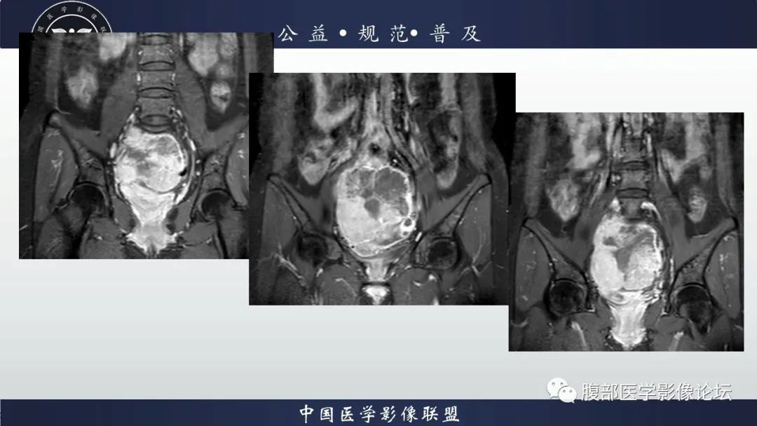 影像PPT - 【病例】卵巢子宫内膜样癌1例MR-10