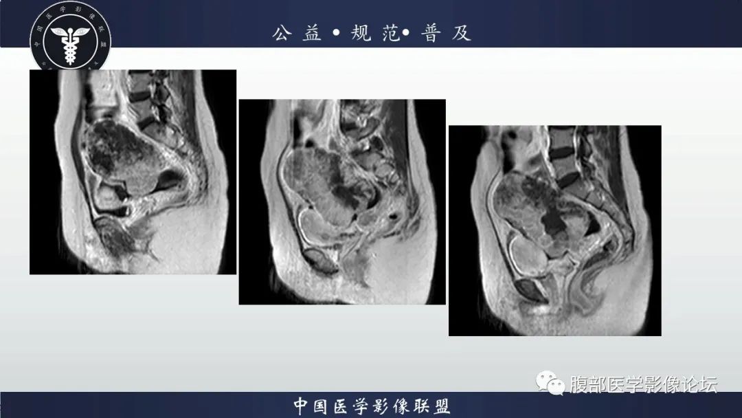 影像PPT - 【病例】卵巢子宫内膜样癌1例MR-11