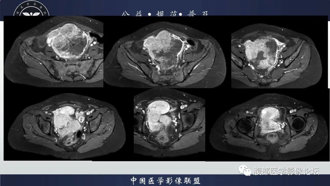 影像PPT - 【病例】卵巢子宫内膜样癌1例MR-9