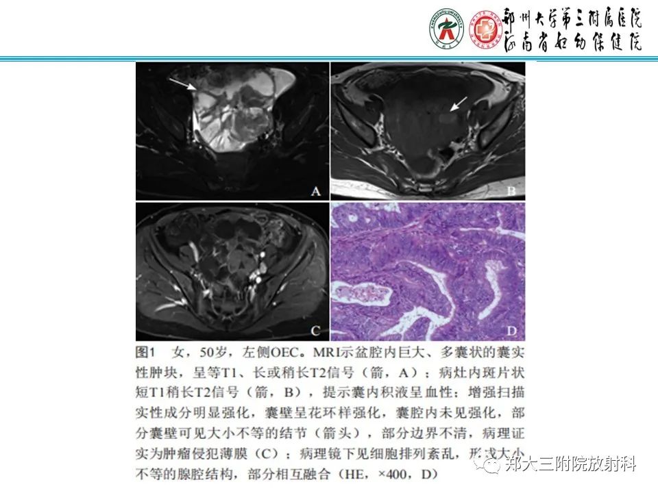 影像PPT - 【病例】卵巢子宫内膜样癌1例MR-16