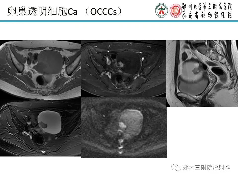 影像PPT - 【病例】卵巢子宫内膜样癌1例MR-19