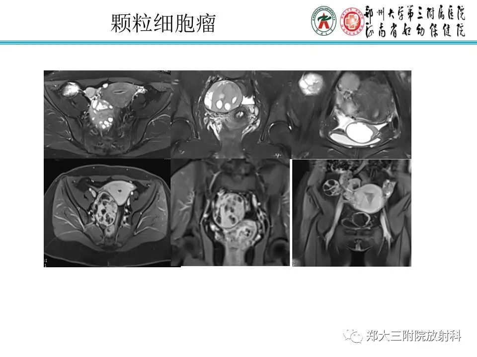 影像PPT - 【病例】卵巢子宫内膜样癌1例MR-25