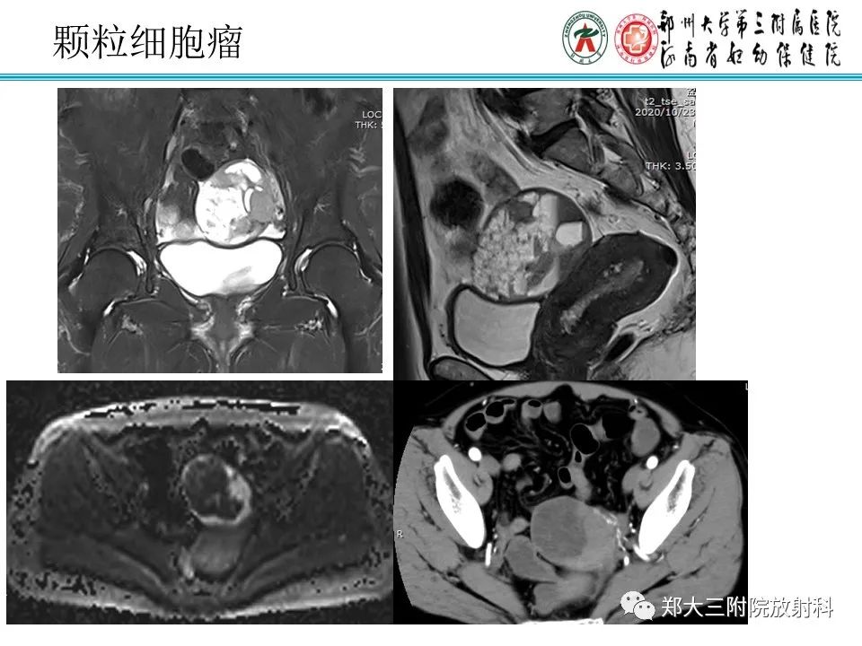 影像PPT - 【病例】卵巢子宫内膜样癌1例MR-26