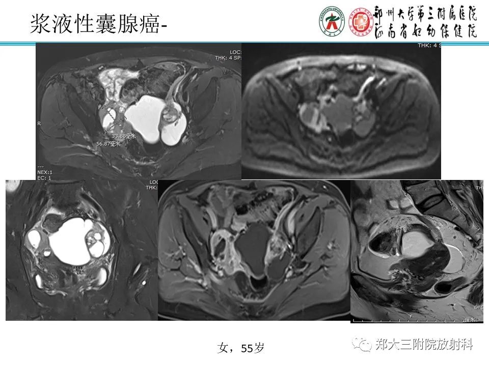 影像PPT - 【病例】卵巢子宫内膜样癌1例MR-28