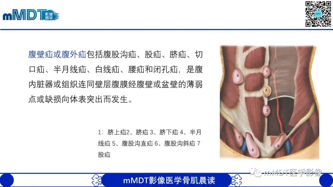 影像PPT - 【PPT】常见腹外疝的影像诊断（修正版）-2