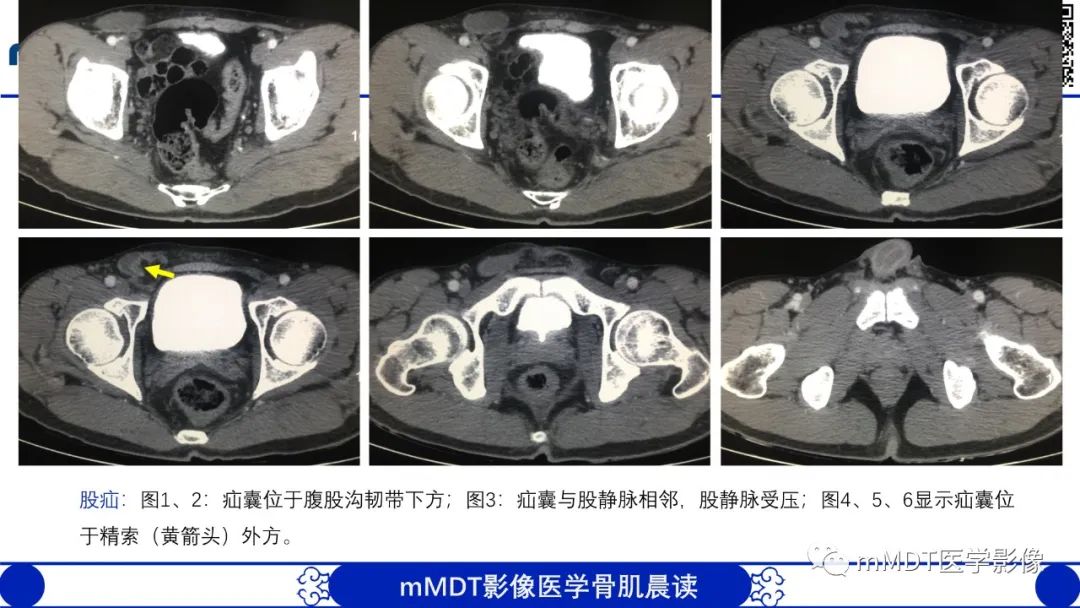 影像PPT - 【PPT】常见腹外疝的影像诊断（修正版）-15